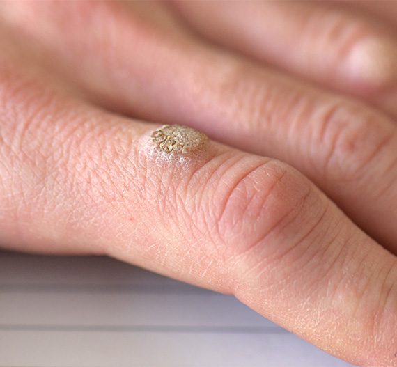Warts on Hands